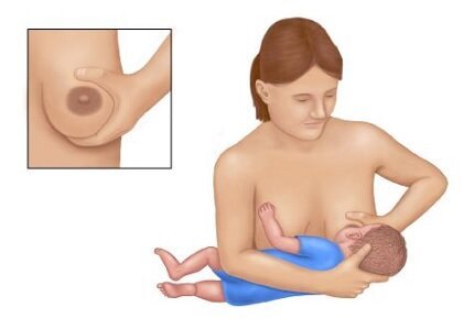 أساس الإطعام الناجح والمريح هو الإمساك الصحيح بطفل حلمة الأم. قبضة صحيحة تتضمن قبضة الحلمة ومعظم الهالات ، مما يخلق ضيقًا ، يسمح للطفل بمص وابتلاع الحليب بشكل مريح. أساس الإطعام الناجح والمريح هو الإمساك الصحيح بطفل حلمة الأم. قبضة صحيحة تتضمن قبضة الحلمة ومعظم الهالات ، مما يخلق ضيقًا ، يسمح للطفل بمص وابتلاع الحليب بشكل مريح.