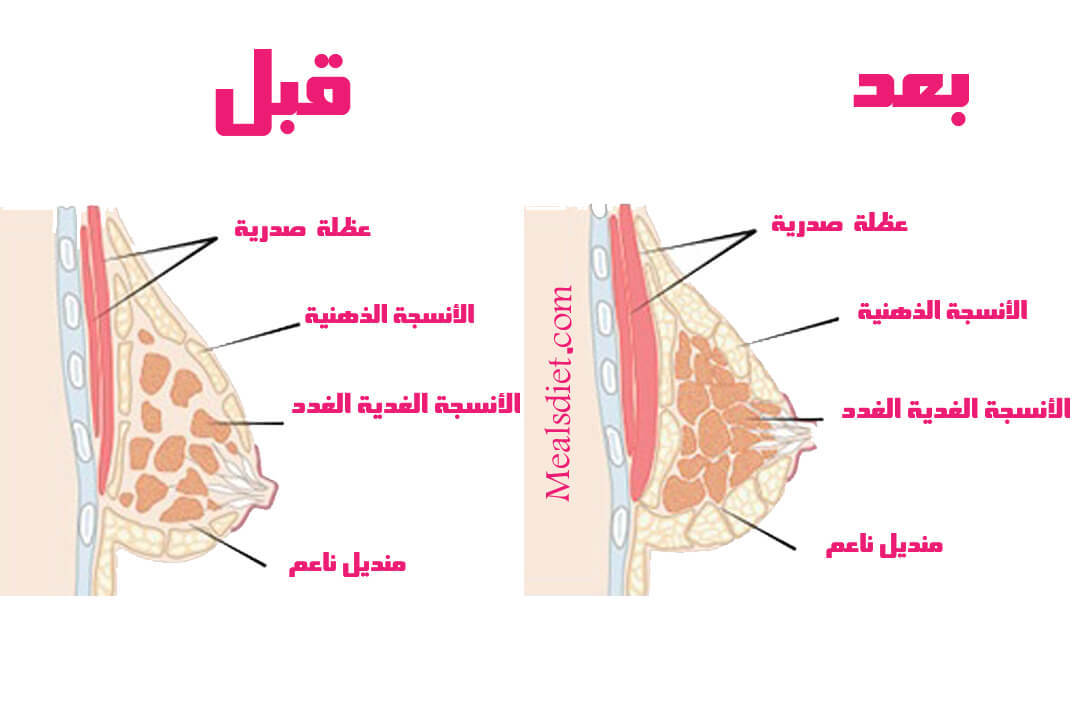قبل وبعد زيادة حجم الثدي(1)